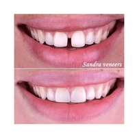 Kit dentaire pour sourire : Facettes dentaires supérieures et inférieures en résine, technologie de collage manuel, usage professionnel