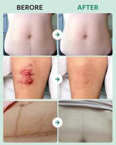 Rollo de Hidrocoloide YOJO para el Cuidado de Heridas - Parches de Hidrocoloide de Grado Médico Extra Grandes, Cortables a Medida, Flexibles e Impermeables - Product Image 5