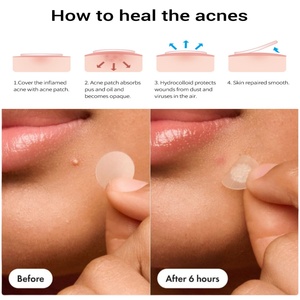 <span class=keywords><strong>Patch</strong></span> de couverture de bouton invisible le plus populaire pour dissimuler les boutons et les imperfections - Product Image 2