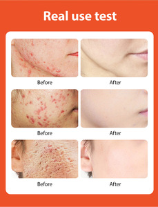 Crème Bio 30g Soin Peau Anti-Boutons Réduit les Pores Hydratante Élimine l'Acné, les Rougeurs et les Gonflements Crème Réparatrice Visage Anti-Acné - Product Image 5