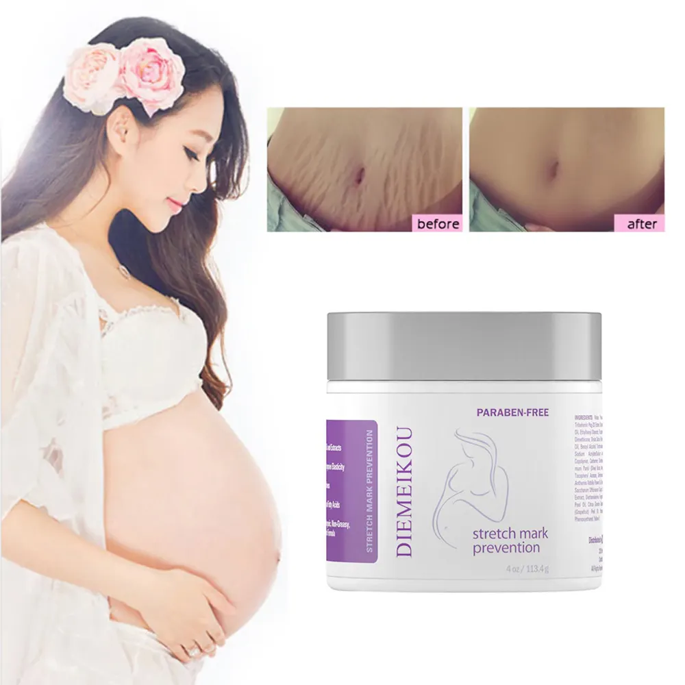 Crema de marca elástica para el embarazo, crema de acné hidratante, ayuda a eliminar cicatrices y prevención