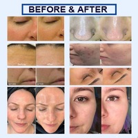 Appareil de soin de la peau 7-en-1 Hydro Aqua Peel Oxygène 2026, analyseur de peau, appareil Hydra Beauty pour salon