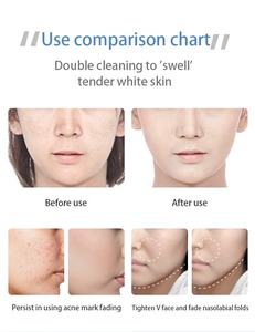 5 in 1 Multifunction Beauty Salon Equipment Facial <strong>Machine</strong> With Microdermabrasion/skin Scrubber/<strong>micro</strong> Current/hot Cold Hammer - Product Image 4