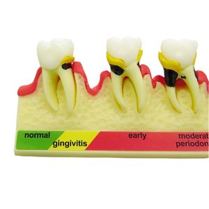 Modelo de Dientes Tipodonto para Demostración del Progreso de la Enfermedad Periodontal, Categoría Patología, para Enseñanza, Estudio y Demostración - Product Image 6