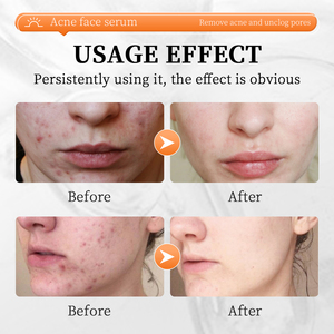 Reparación rápida y eficaz, suero facial para espinillas, acné, piel suave, reduce los poros, suero de ácido salicílico - Product Image 6