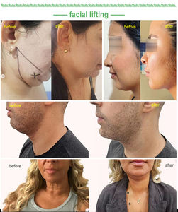 <span class=keywords><strong>Endo</strong></span> laserlift 1470nm machine laser liposuccion 1470 machine dispositif médical - Product Image 3