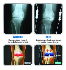 Attelle de Genou Orthopédique de Décompression et de Soulagement pour l'Arthrose, les Déchirures du Ménisque et la Pression Osseuse - Product Image 4