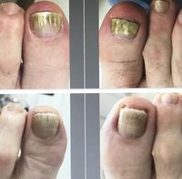 Laser d'élimination des champignons des ongles 980nm laser d'orteils laser de podiarité verrues plantaires