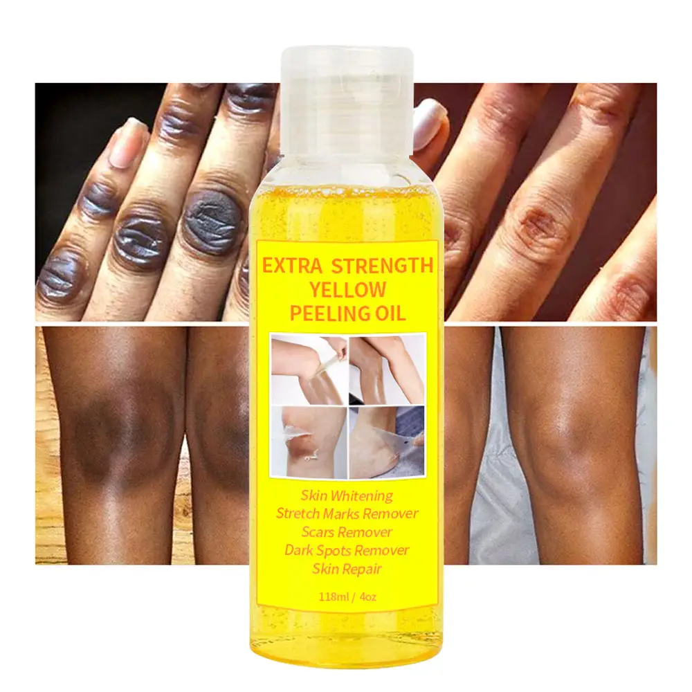 Super Strength Yellow Peeling Oil Aufhellen Ellbogen Knie Hände Melanin Bleichen Dunkle Haut Starkes Peeling Öl