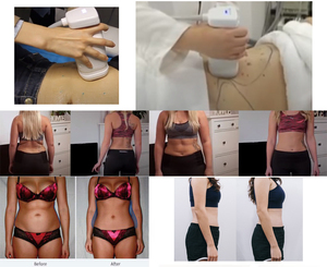 Máquina Portátil de Reducción de Grasa Liposonic Au-S901, Equipo de Ultrasonido Focalizado para Adelgazamiento Corporal HIFU - Product Image 5