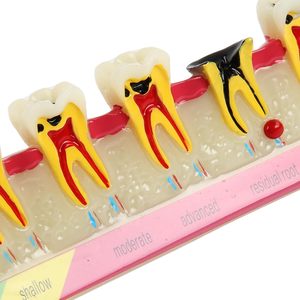 Dental <b>Teeth</b> Model 6-Stage Caries Development Educational Model for Periodontal Disease Patient Display - Product Image 5