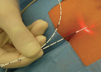 Bonne qualité 980nm meilleurs traitements des hémorroïdes fistule fissure Pilonidal Sinus dispositif