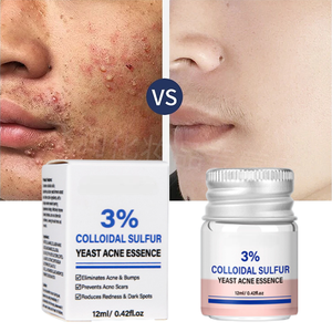 Korean Organic Best Face Cream control de aceite lavado tratamiento de ácido salicílico glicólico eliminación de levadura suero antiacné para espinillas - Product Image 3
