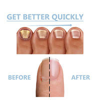 Traitement antifongique des ongles, Essence de soin des pieds, Anti-infection, Élimination de l'onychomycose, Soin des ongles des orteils, Mycose des pieds, Paronychie, Soin des ongles, Corps