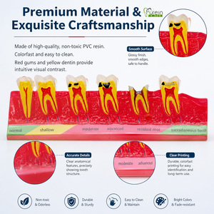 Modèle éducatif sur la progression des caries dentaires, directement de l'usine, pour les cliniques dentaires, les écoles et la formation des patients. Marque privée. - Product Image 3