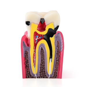 Azdent modello di insegnamento dentale 6 volte carie due lato contrasto anatomico per l'educazione del paziente e spiegazione - Product Image 2