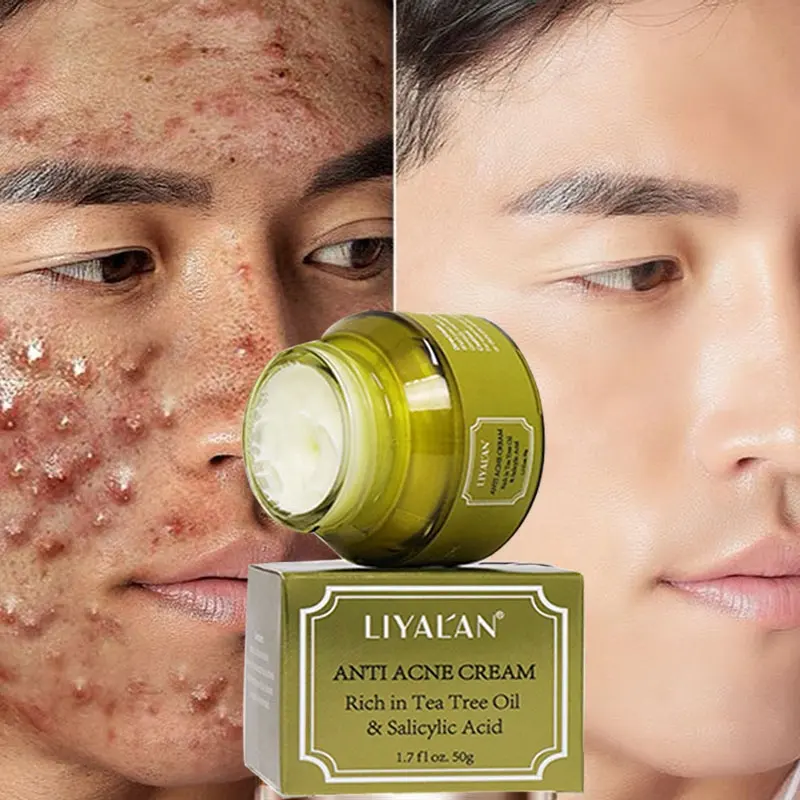 Herbal Treatment Skin Lotion Face Acne Scar Pimples Dark Spot Remover Salicylic Acid Tea Tree Oil Anti Acne Cream