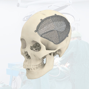 Cadre de reconstruction du visage médial (<span class=keywords><strong>Le</strong></span> Fort) en titane imprimé en 3D sur mesure - Product Image 4