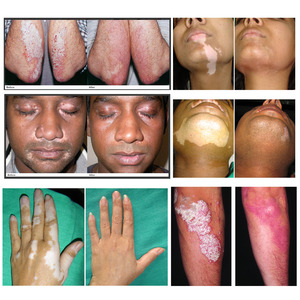 Laser excimère 308 nm, lumière ultraviolette 308 nm pour le traitement du vitiligo, du <span class=keywords><strong>psoriasis</strong></span> et de l'eczéma, photothérapie 308 nm - Product Image 5