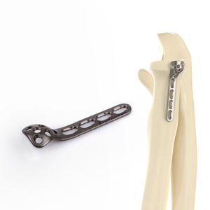 Canwell แผ่นล็อครัศมีวงแหวนไทเทเนียมขนาดยาวพิเศษสองคอลัมน์แผ่นฟิบูลาจานแปรผัน3รู2.4มม. - Product Image 2