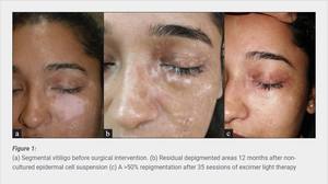 Çekirdek dermatoloji 308nm Excimer ışık UVB fototerapi Vitiligo sedef hastalığı tedavi lambası KN-5000C 55mW/cm² - Product Image 6