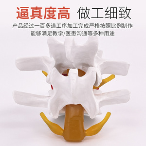 Modelo de columna lumbar, para la demostración médica de la compresión del disco intervertebral lumbar y la patología de osteófitos espinales. - Product Image 3