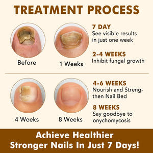 SEFUDUN <span class=keywords><strong>Meilleur</strong></span> sérum réparateur de croissance <span class=keywords><strong>des</strong></span> <span class=keywords><strong>ongles</strong></span> endommagés 60 ml, à base de plantes, <span class=keywords><strong>traitement</strong></span> antifongique <span class=keywords><strong>des</strong></span> <span class=keywords><strong>ongles</strong></span> en 7 jours, huile nourrissante <span class=keywords><strong>pour</strong></span> les mains et les pieds - Product Image 5