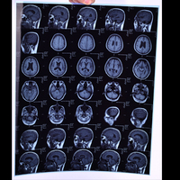 Film Termal Medis Kering 8x10 Inci Biru PET untuk Pencetakan Diagnostik Radiologi Rumah Sakit