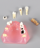 Modelo de Tratamiento de Caries con Puente de Caries e Implante