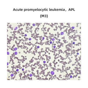 Huyết học chuẩn bị Slide máu smear cấp tính promyelocytic bệnh bạch cầu M3 APL - Product Image 2