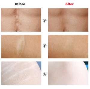 Lotion crème vergetures de marque privée meilleure crème <span class=keywords><strong>anti</strong></span>-vergetures à base de plantes pour réparer les cicatrices et les vergetures - Product Image 4