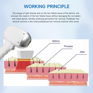 Livraison rapide, machine d'épilation au <span class=keywords><strong>laser</strong></span> à diode à 4 longueurs d'onde, 10 barres, haute puissance, pour tous les types de peau, vente flash - Product Image 4