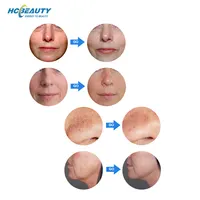 HCBEAUTY oxygen spray facial beauty RF improve skin dull acne professional skin care machine