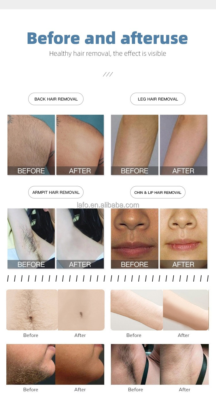 nd yag laser tattoo removal 2 in 1 diode laser hair removal +Picosecond laser nd yag q switch