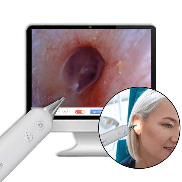 Tingoton Smart Video Otoscope Camera Ear Speculum 1280x720 Resolution 30FPS Adjustable LED Light Source MJPG Clinics Hearing
