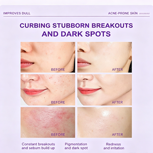 Crème visage à 12 % d'acide azélaïque avec niacinamide, vitamine C, hyaluronate de sodium, pour unifier le teint, atténuer les marques d'acné, déboucher les pores - Product Image 3
