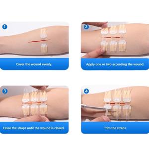 Dispositivos médicos desechables Cierre de piel no invasivo Yeso para heridas Cierre de heridas Cremallera - Product Image 4