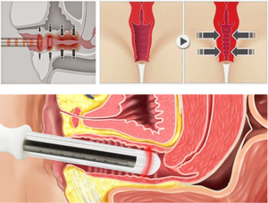 Laser Diode minimal invasif, 980nm + 1470nm perangkat terapi ginekologi digunakan untuk mengencangkan vagina/peremajaan vagina - Product Image 6