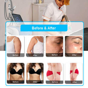 Máquina de Vacumterapia Multifuncional de Alta Calidad con 4 Manijas para Moldear el Cuerpo, Pérdida de Peso y Drenaje Linfático - Product Image 6