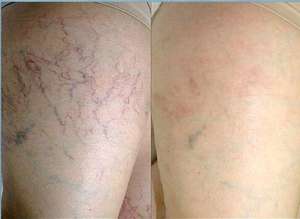 Máquina pequeña de eliminación de venas de araña, máquina portátil de eliminación de <span class=keywords><strong>verrugas</strong></span> <span class=keywords><strong>planas</strong></span>, máquina de eliminación de venas de araña láser de diodo de 980nm - Product Image 3