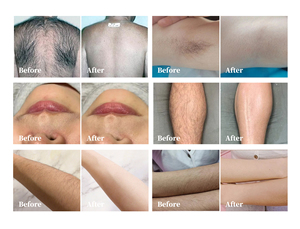 Épilateur sans fil en acier inoxydable avec technologie de refroidissement par glace, indolore, pour une épilation permanente et un rajeunissement de la peau à domicile - Product Image 5