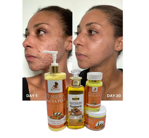 ชุดครีมบำรุงผิวสำหรับรักษาสิว tumeric + <span class=keywords><strong>gluta</strong></span> <span class=keywords><strong>PLUS</strong></span> สารเพิ่มความขาวต่อต้านริ้วรอยและสิว - Product Image 6