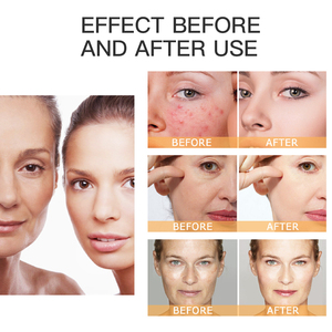 Aiooce Tonique à l'acide glycolique pour l'élimination de l'acné et des comédons, contrôle du sébum, resserre les pores, hydrate et adoucit la peau (Ordinaire) - Product Image 5