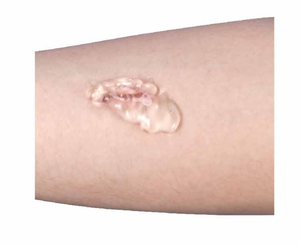 เจลปิด<span class=keywords><strong>แผล</strong></span>ไฮโดรเจลแบบอัมฟอร์มัสชนิดฉีดสำหรับการดูแลแผลแบบ Autolytic Debridement สำหรับ<span class=keywords><strong>แผล</strong></span>ไฟไหม้ <span class=keywords><strong>แผล</strong></span>อักเสบ ได้รับการรับรองมาตรฐาน CE - Product Image 4