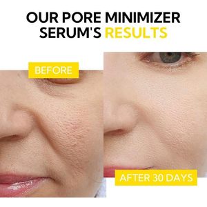 Traitement pour le visage pour éliminer les points noirs, contrôler le sébum, raffermir, réduire la sécheresse, resserrer les pores, pour les peaux végétaliennes et biologiques, 30 ml, traitement minimiseur de pores - Product Image 5