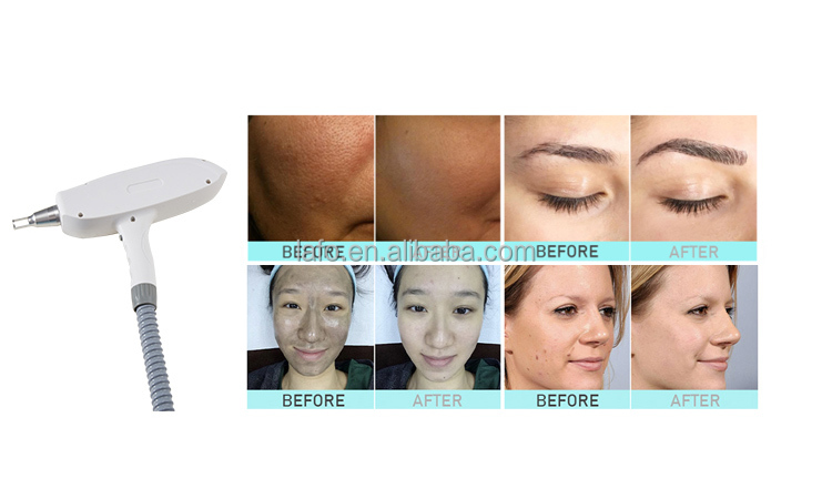 NEW design! 4 in 1 opt IPL+ 808nm diode laser + rf +nd yag laser beauty salon equipment ipl laser hair removal machine