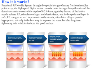 Nouvel appareil de microneedling RF 2026 à quatre aiguilles isolantes pour l'élimination des cicatrices, l'élimination de l'acné et la réparation cutanée - Product Image 2
