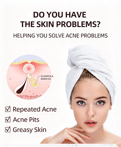 Gel Soin Anti-Acné, Crème Réparatrice Douce pour la Peau, Améliore les Marques d'Imperfections, Affine la Texture de la Peau, Soin du Visage - Product Image 3