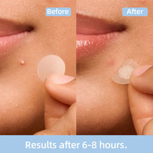 Patchs Hydrocolloïdes Anti-Acné DE, Réduction des Cicatrices, Taille Voyage, Mighty Patch Coréen, Patchs Anti-Acné pour le Dos, Résultats Nuit, Vente Directe Usine - Product Image 5