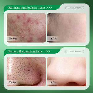 SADOER-Loción de ácido salicílico OEM, suero, corrector de manchas oscuras, tratamiento facial diario para pieles sensibles y propensas al acné - Product Image 4